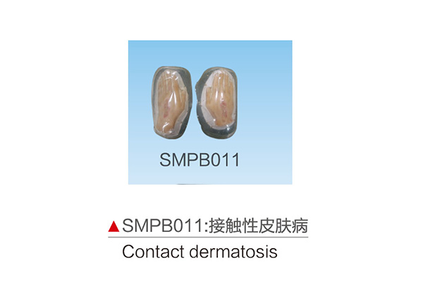 SMPB011       接觸性皮膚病